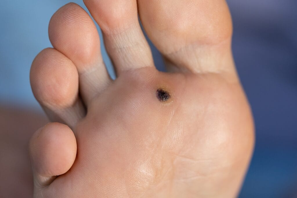 Closeup of wart plantar after cauterizing it with celandine on infected foot. Papillomavirus or HPV