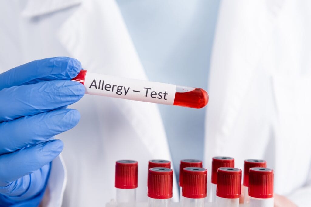 Cropped view of doctor holding tube with allergy test lettering