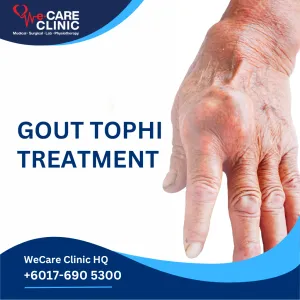 Gout Tophi Treatment - Medical management